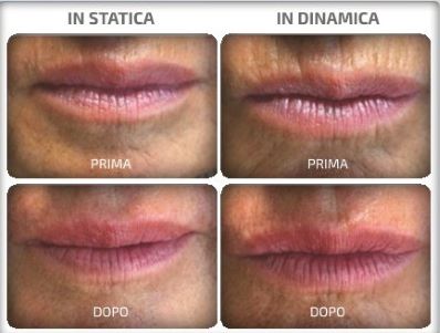 Trattamenti Laser Viso